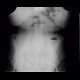 Small bowel obstruction, ileus, Crohn's disease: X-ray - Plain radiograph